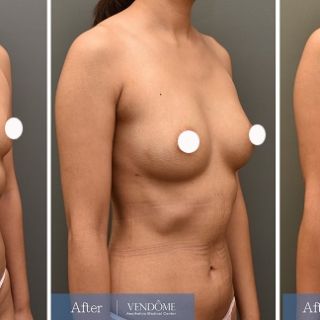 療程效果因人而異，上圖為B罩杯產後女性在做完自體脂肪隆乳之後​手術後一個月、手術後六個月成效